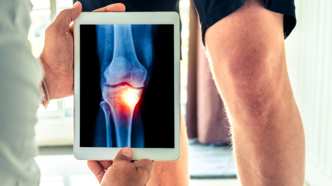 Genou affecté par de l'arthrose ou de l'arthrite.