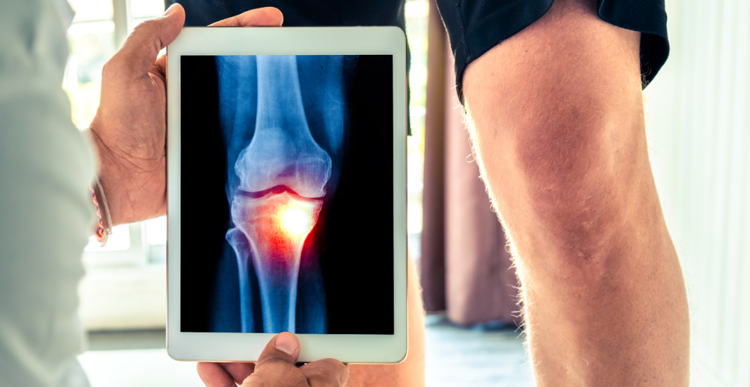 Arthrose-arthrite-comment-faire-la-difference