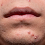 acne signe carence en zinc