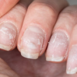 ongles faibles signe carence en zinc