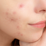 Inflammation du au stress