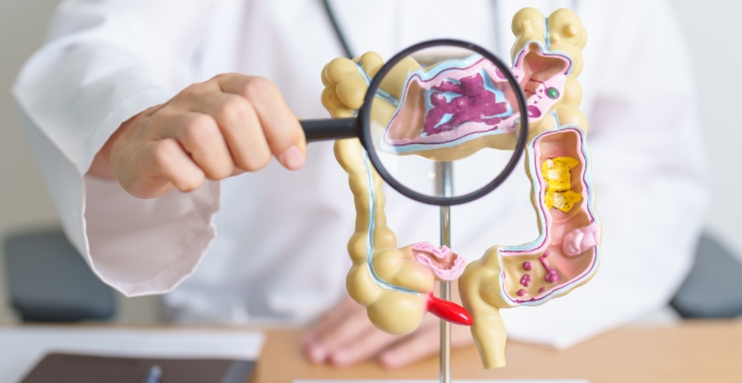 Le Syndrome de l’Intestin Irritable : Comment Reconnaître les Symptômes et Soulager les Crises
