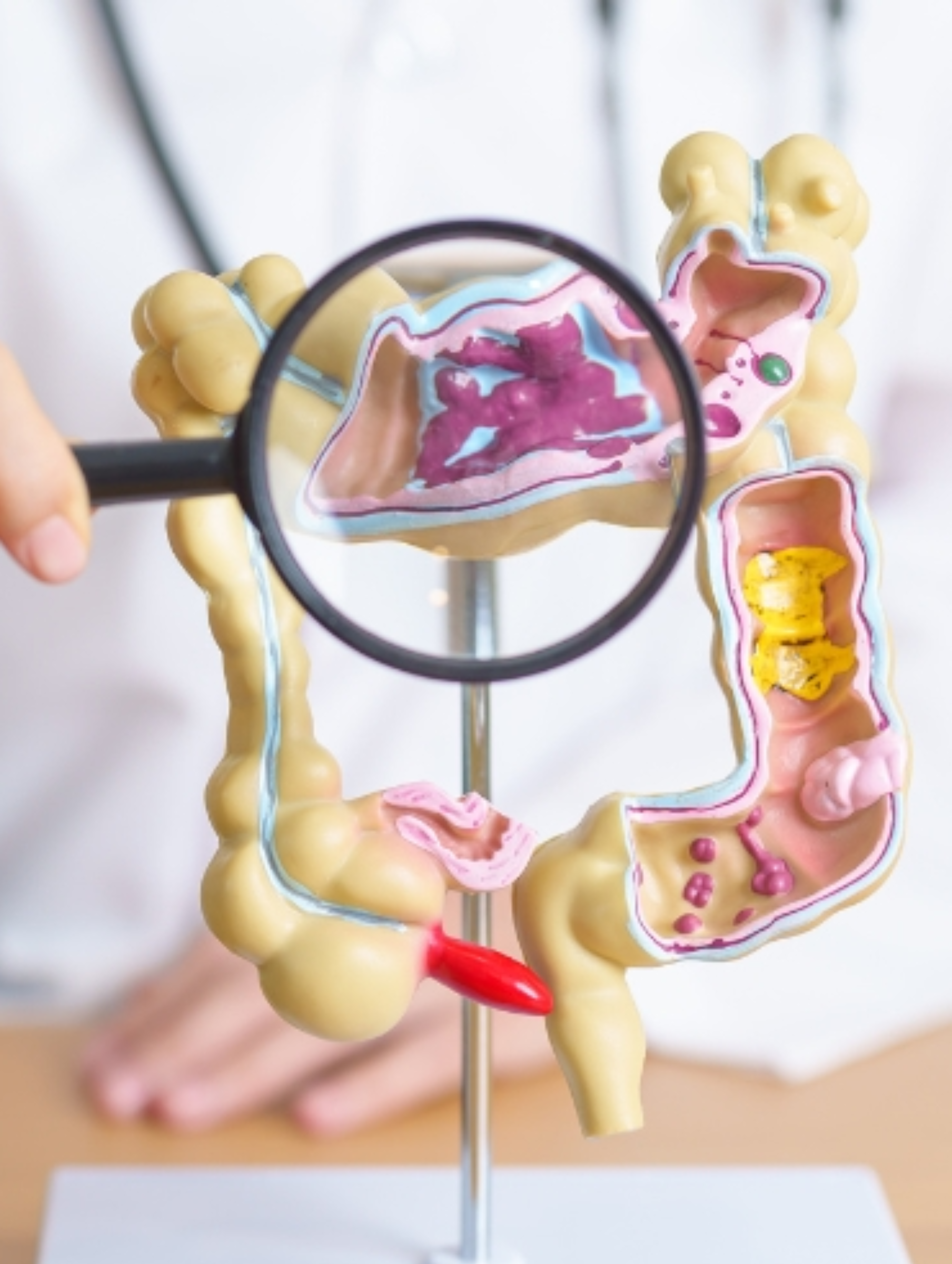 Le Syndrome de l’Intestin Irritable : Comment Reconnaître les Symptômes et Soulager les Crises ?