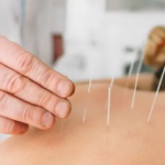 acupuncture pour soulager la constipation
