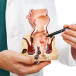 complications constipation comme Hémorroïdes